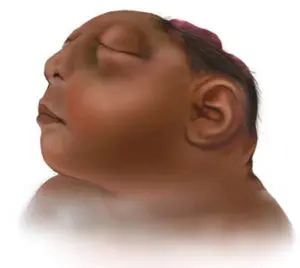 Fetus Suffering From Anencephaly, Woman’s Plea To Terminate Her 28-Weeks Pregnancy Allowed by the Delhi HC